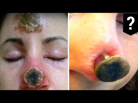สาเหตุของอาการแพ้ภูมิแพ้ อาหารโภชนาการสำหรับโรคสะเก็ดเงิน