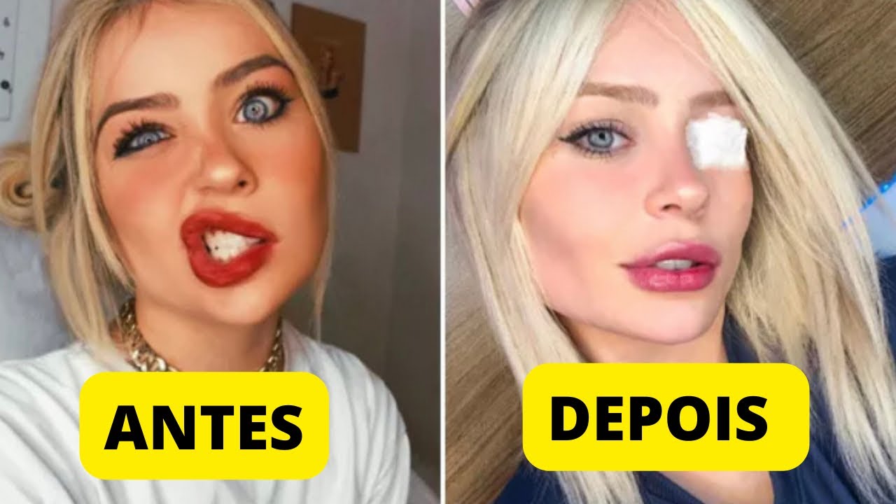 PARALISIA DE BELL, MELHOR TRATAMENTO PARA COMEÇAR AGORA #paralisiafacial