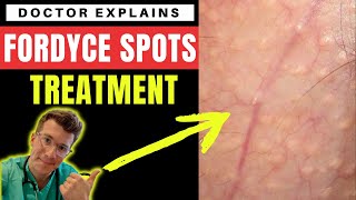 How to treat FORDYCE SPOTS - Doctor O