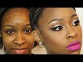 How To Cover Acne Scars And Bumps| MAKEOVER MONDAY Makeup + Hair EP.1