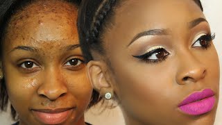 How To Cover Acne Scars and Bumps| MAKEOVER MONDAY Makeup + Hair EP.1