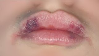 how to get rid of lip bruises after kissing