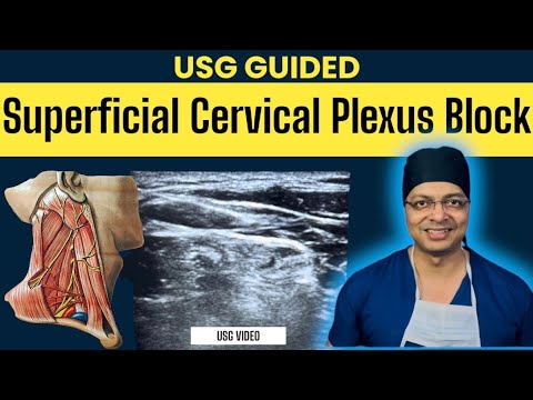 USG GUIDED SUPERFICIAL CERVICAL PLEXUS BLOCK | Cervical plexus anatomy | Real USG video of BLOCK.