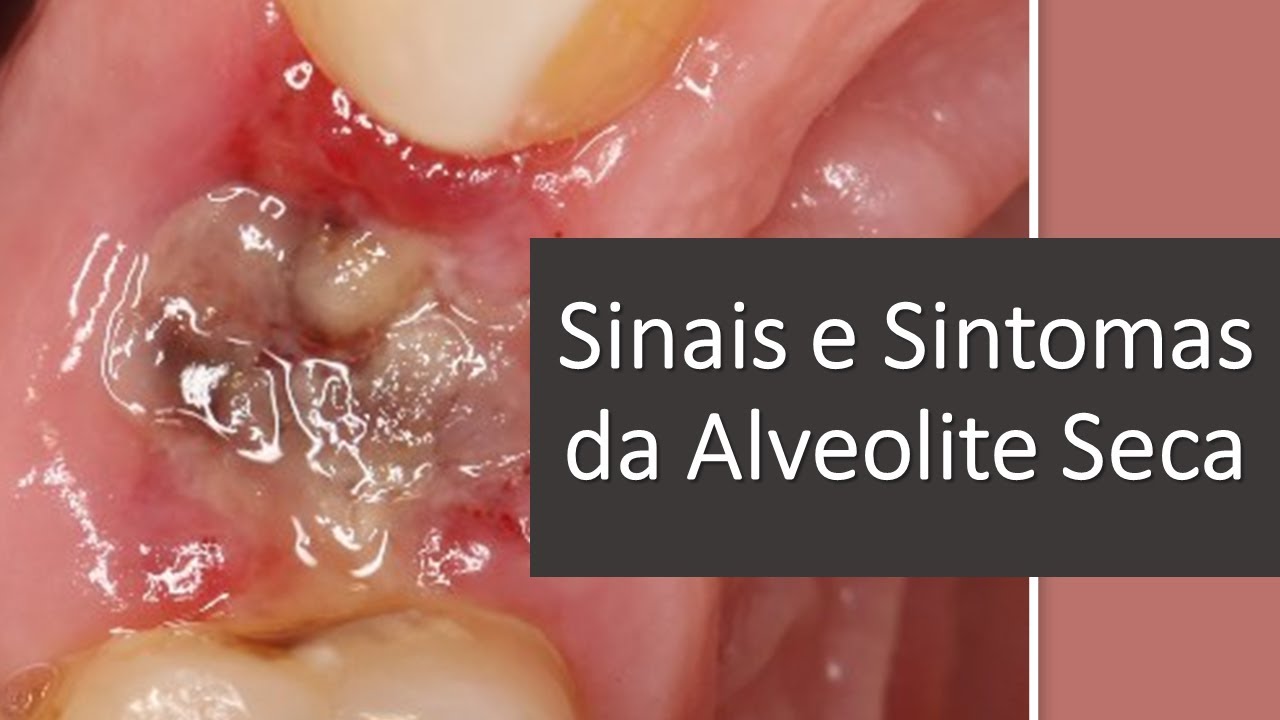 Sinais e sintomas da Alveolite seca | Odontologia | Dra Bianca Rosa