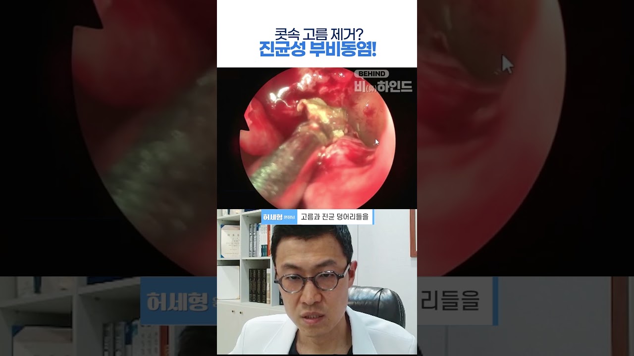 콧속 고름 제거? 진균성 부비동염!