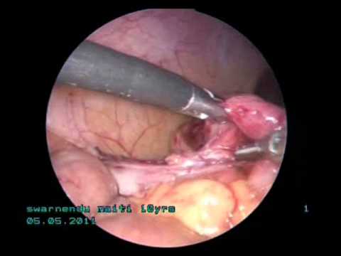 subhepatic retrocaecal appendix - laparoscopic management