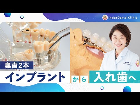 奥歯2本インプラントから入れ歯へ
