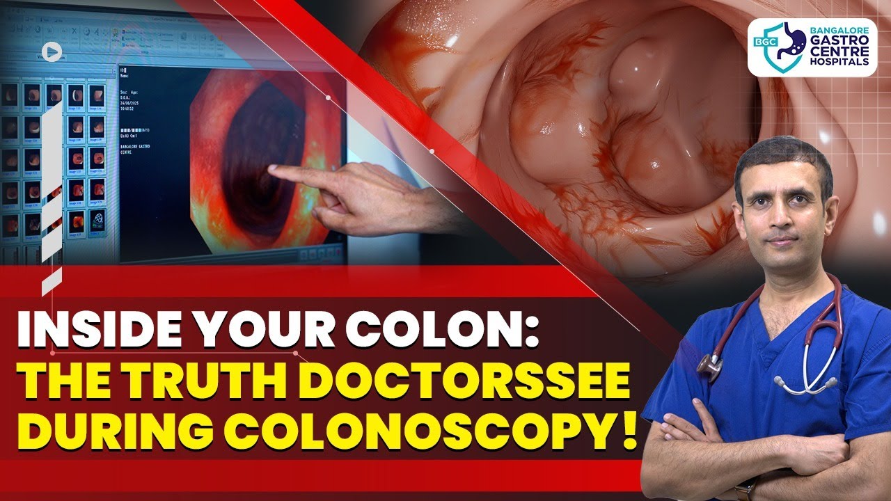 Inside Your Colon: Real Colonoscopy Findings—Polyps, Inflammation & Cancer Red Flags Explained