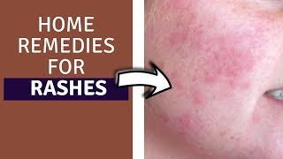 home remedies for rashes - how to get rid of rashes fast | home remedies for rashes on face