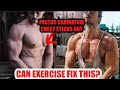 Exercise to Fix PECTUS CARINATUM!? Exercise to Fix PECTUS CARINATUM!?