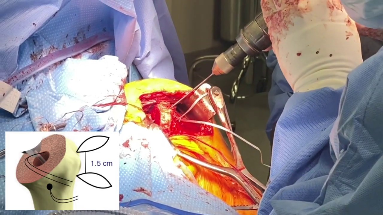 Dr. Garcia demonstrates his cutting edge technique for subscapularis repair after stemless...