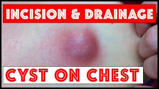 I &amp; D (Incision &amp; Drainage) of an Inflamed Cyst, Left Chest