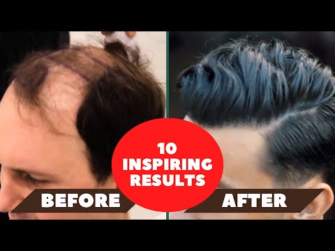 10 inspirerande hårtransplantationsresultat