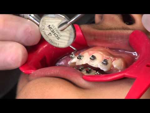 Klejenie zamków ortodontycznych - część 3
