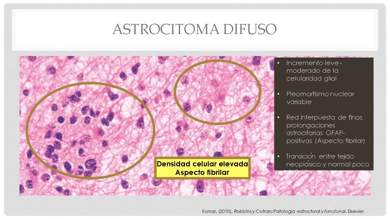 Astrocitomas Patología Morfológica y Funcional IV
