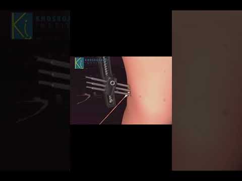How to Take Care of Pins After External Fixation