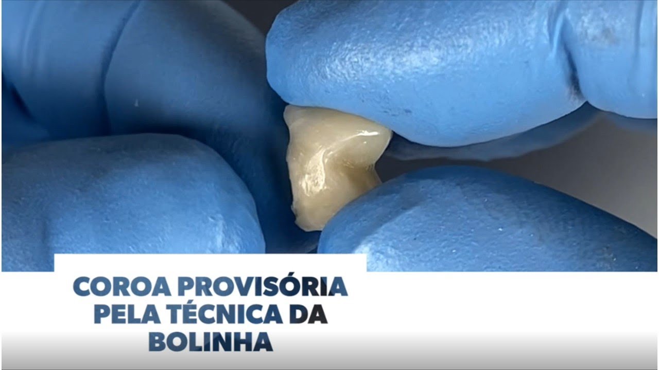 Coroa provisória posterior pela técnica da bolinha