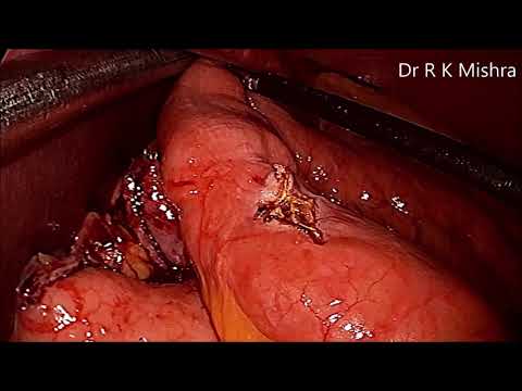 Novel Technique of Laparoscopic Mini Gastric Bypass