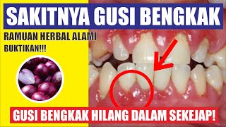 Download lagu Obat Herbal Atasi Gusi Bengkak Agar Cepat Kempes Paling Ampuh mp3