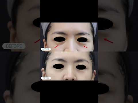 Best Dark Eye Circle Treatments in Subang Jaya