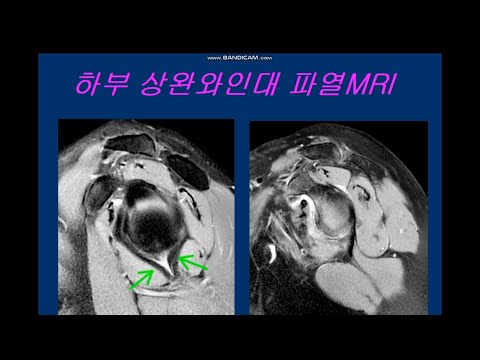 하부 상완와인대 파열MRI