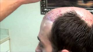 Hair Transplant Surgery