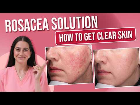 How I cleared my skin: Rosacea Solution