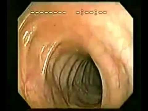Papillary urothelial bladder cancer