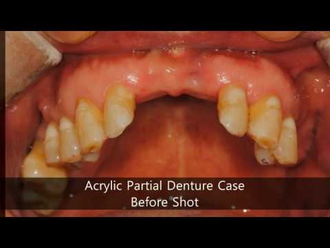 Emergency Denture Services Available at Denture Square Brisbane