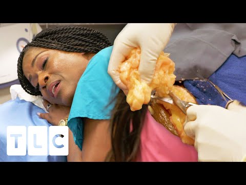 Woman Sings While Dr Lee Removes Her &quot;Talkative&quot; Lipoma | Dr. Pimple Popper Pop Ups