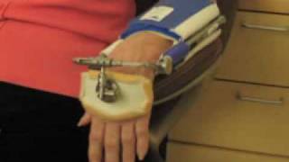 preview picture of video 'Denise's Wrist Dynasplint®  Recovery'