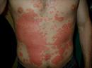 Eczema secco nazionale Crema di dermatite di atopic durante un secolo