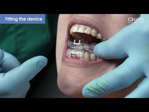 Gutiera Antisforait ONIRIS -  Montarea Dispozitivului