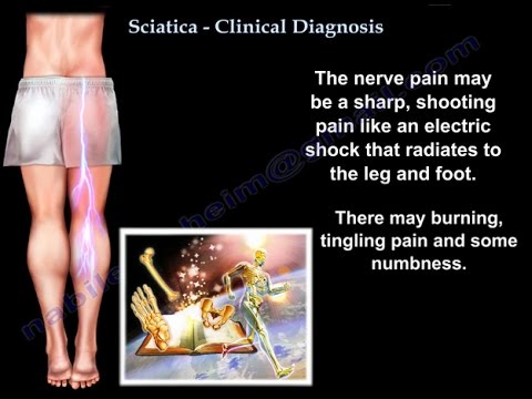 Sciatique - Diagnostic clinique