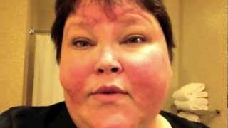 Lupus 2-26 &amp; 27-12 How much blood?... Stem Cell Transplant