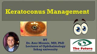Keratoconus Management