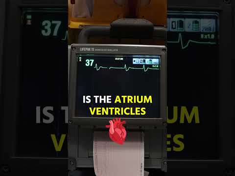 COMPLETE Heart Block on EKG