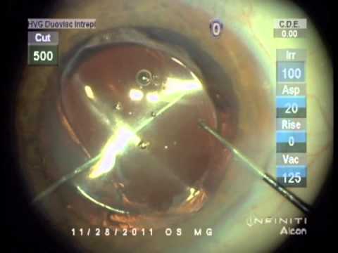 Captura óptica para centrar y fijar una lente intraocular inclinada