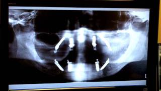 preview picture of video 'Alouf Dentistry Teeth In A Day Implants Salem Roanoke, VA'
