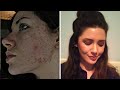 My Full Skin Care Routine For Acne & Scar Fading ...