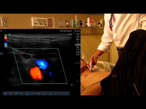 Angle dependence of Color Doppler