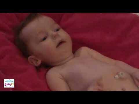 Learn to Spot the Warning Signs of SMA – Floppy Baby (Video 5)