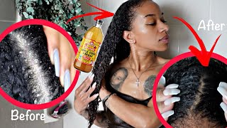 HOW TO STOP DRY ITCHY SCALP & PREVENT DANDRUFF| APPLE CIDER RINSE