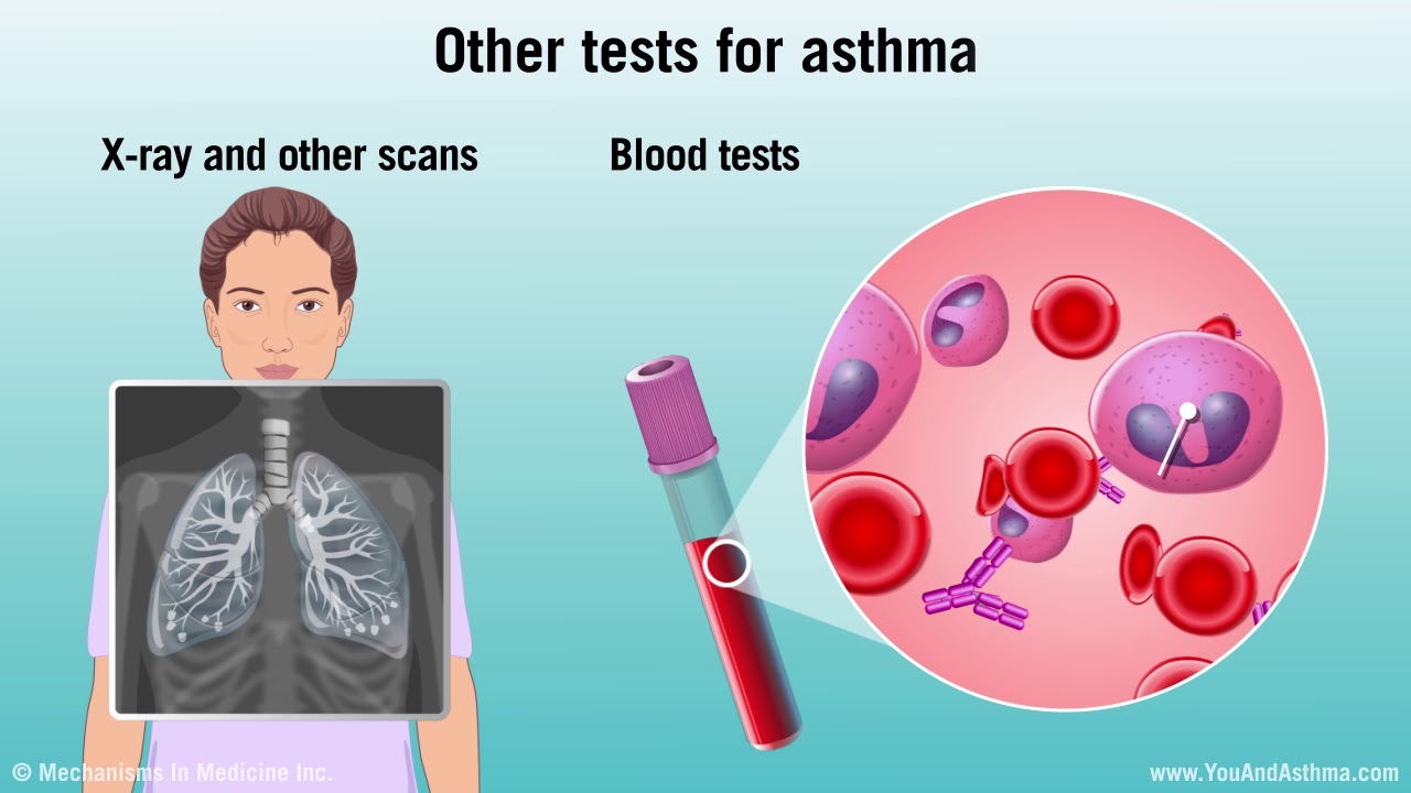 Diagnosing Asthma: Mild, Moderate, and Severe
