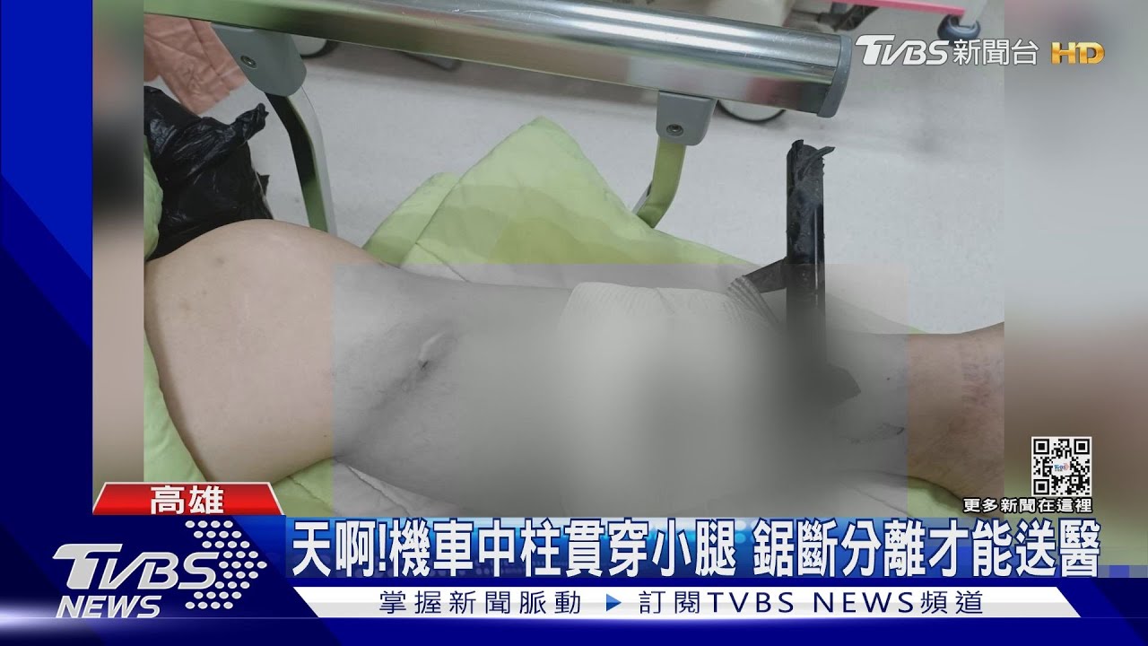 竟然會有這種事!女遭機車中柱貫穿小腿 鋸斷分離再送醫