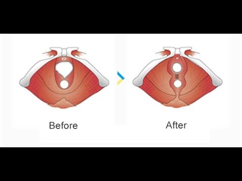 hymenotomy And hymenectomy; surgical procedures involving the hymen, typically to correct congenital