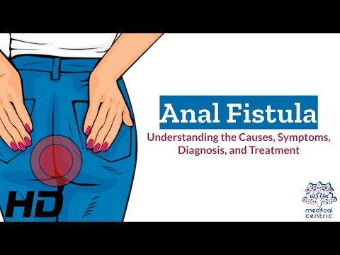 Anal Fistula Explained: Causes, Symptoms, and Treatment