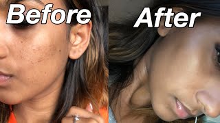 How I Got Rid Of Acne Scars and Got Clear Skin In One Week ( WITHOUT SPENDING $$ )