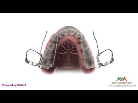 Orthodontic Expander or Spacer - Quad Helix Appliance