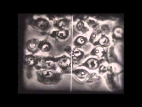 Nickel Allergy From A Cell Phone. Part 1 of 3 – Dr. Leslie Knight